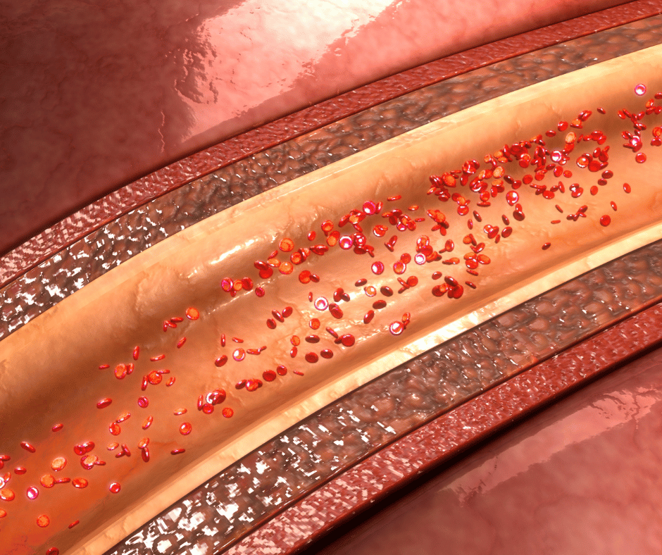 ilustracja naczynia krwionośnego wraz ze strukturami których uszkodzenie powoduje chorobę wieńcową